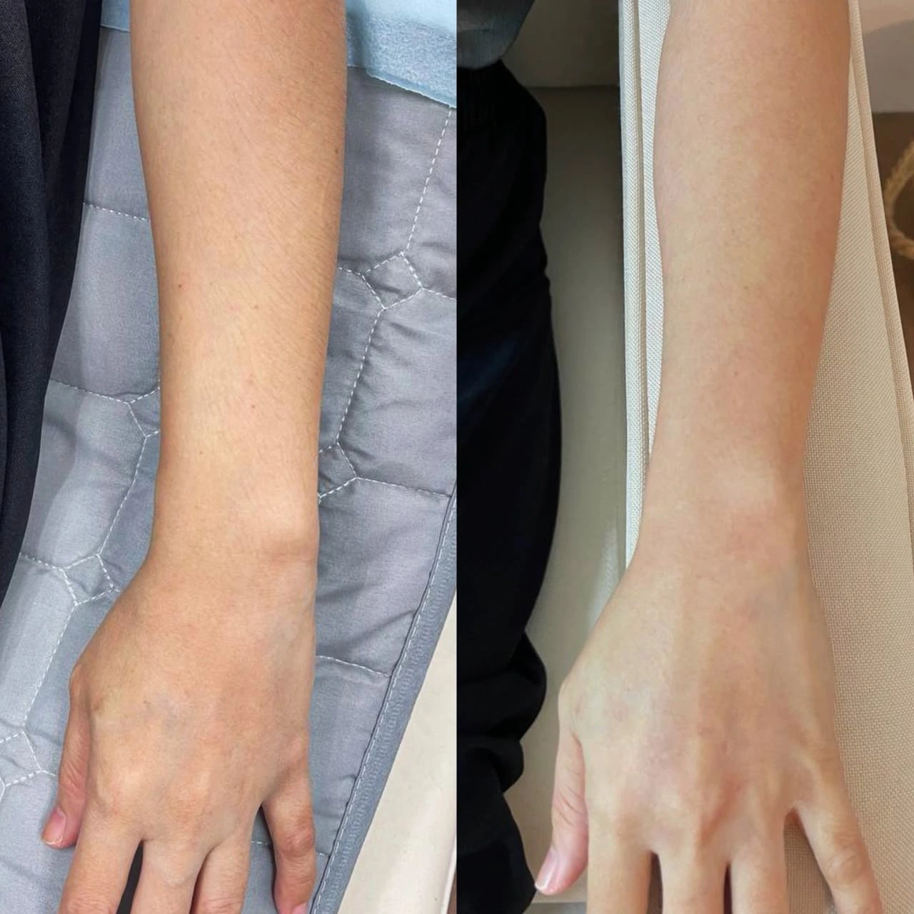 SkinzCantik forearm treatment comparison