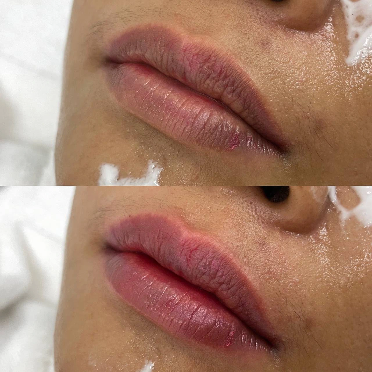SkinzCantik lip treatment comparison